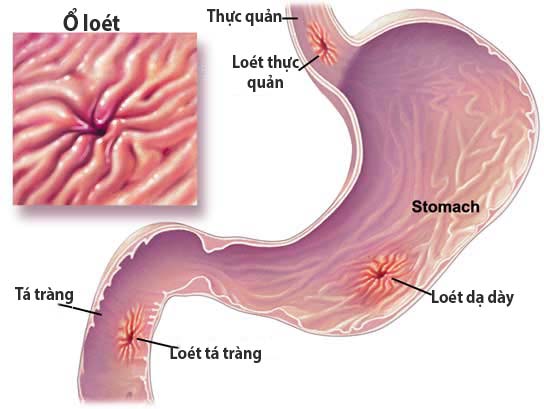 Duodenal Cancer - Hình ảnh minh họa